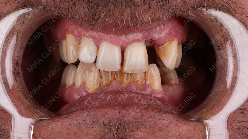 Before treatment